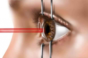 Laser Eye Surgery In  India
